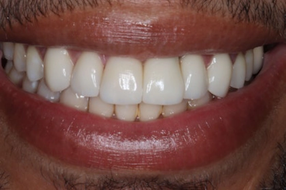 Close-up of a smile showing white teeth