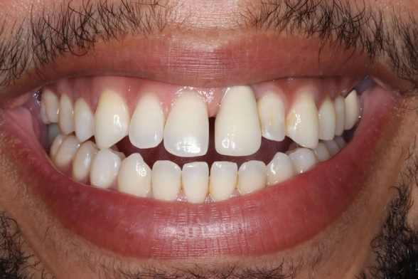 Close-up of a smile showing white teeth, alternate angle