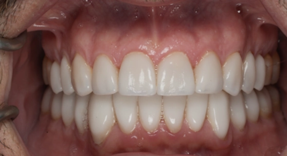 Close-up of teeth showing staining