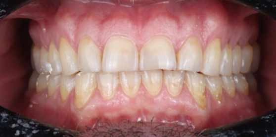 Close-up of teeth showing staining, alternate angle