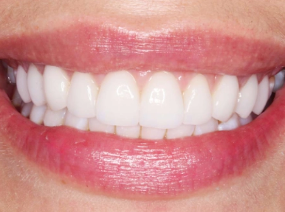 Close-up of a smile showing white teeth