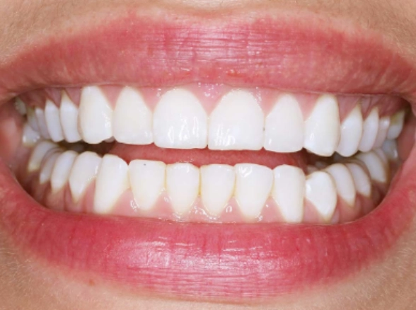 Close-up of a smile showing white teeth, alternate angle