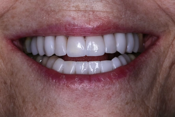 Close-up of a smile showing white teeth