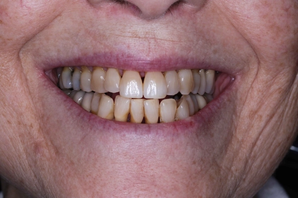 Close-up of a smile, possibly showing veneers