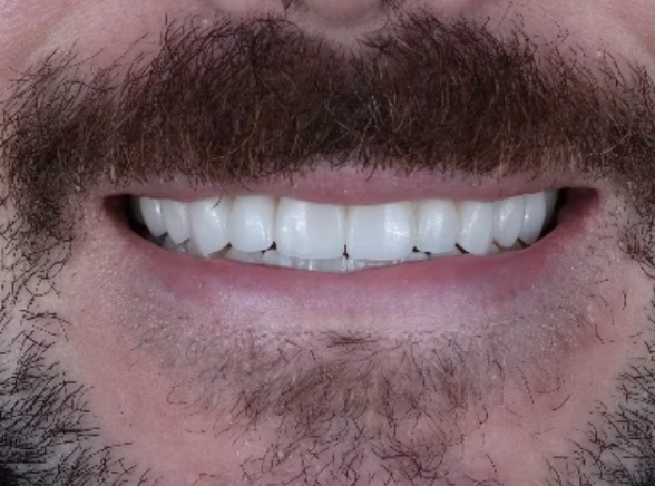 Close-up of a white smile, person with beard