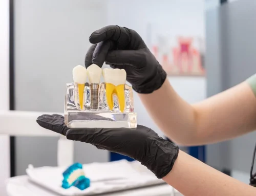 5 Dental Implant Myths Debunked