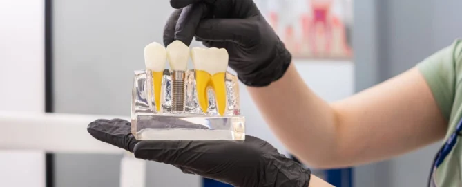 Dental Implants in