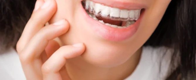 Invisalign in